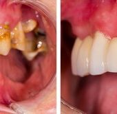 Patients teeth before and after dental treatment.
