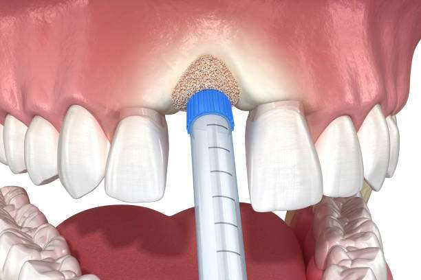 Dental Bone Graft in Tijuana