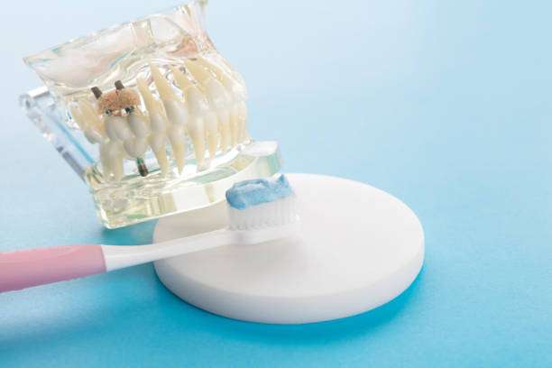 implant and orthodontic model for student to learning teaching model showing teeth.