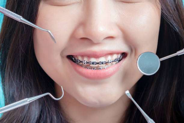 Close up Dental braces of woman wearing braces beauty smile with white teeth increase confidence for healthy on blue background isolated studio shot, Happiness teenager smiling concept.