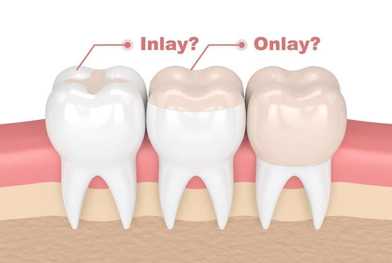 Inlays and Onlays in Dentistry: The Best Exploration